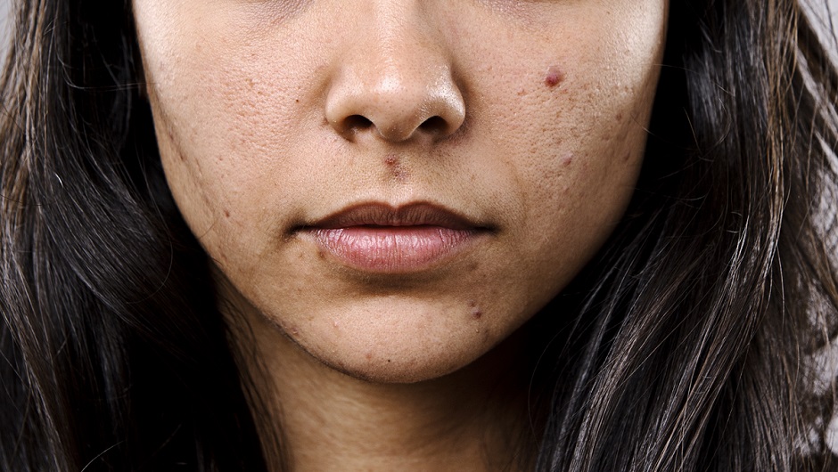 Acne skin prone hypebae improve source tips Acne Tips | How To Care For Acne