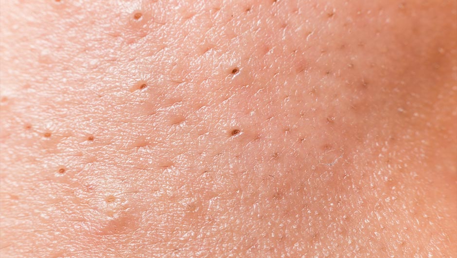 The One Thing You Should Never Do To Your Blackheads