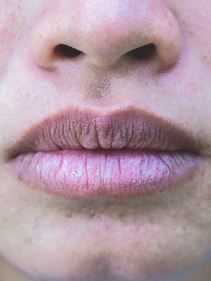 dry lips