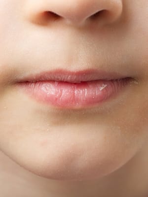 dry lips