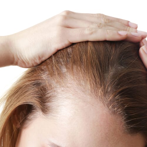 thinning red hair