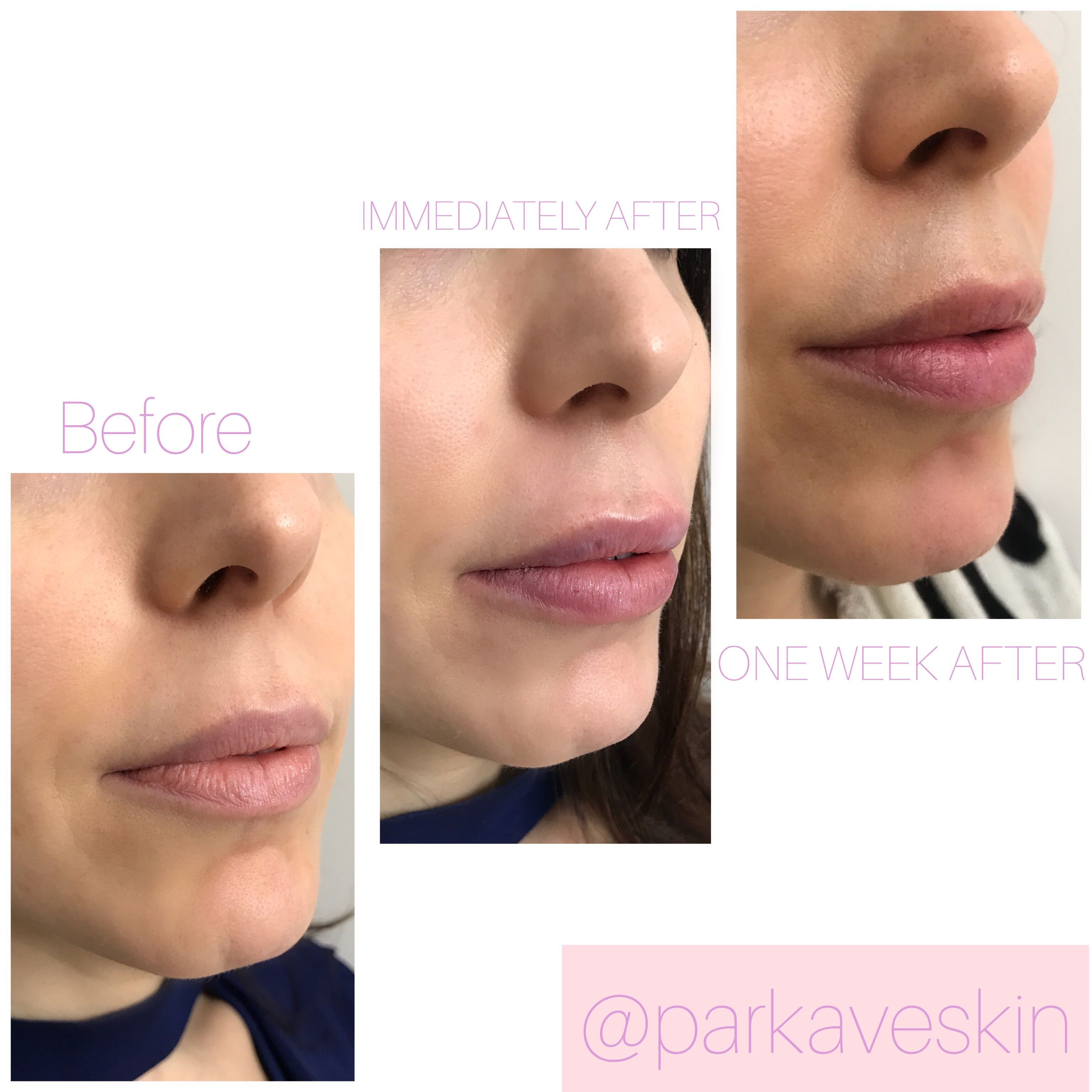 before and after lip filler