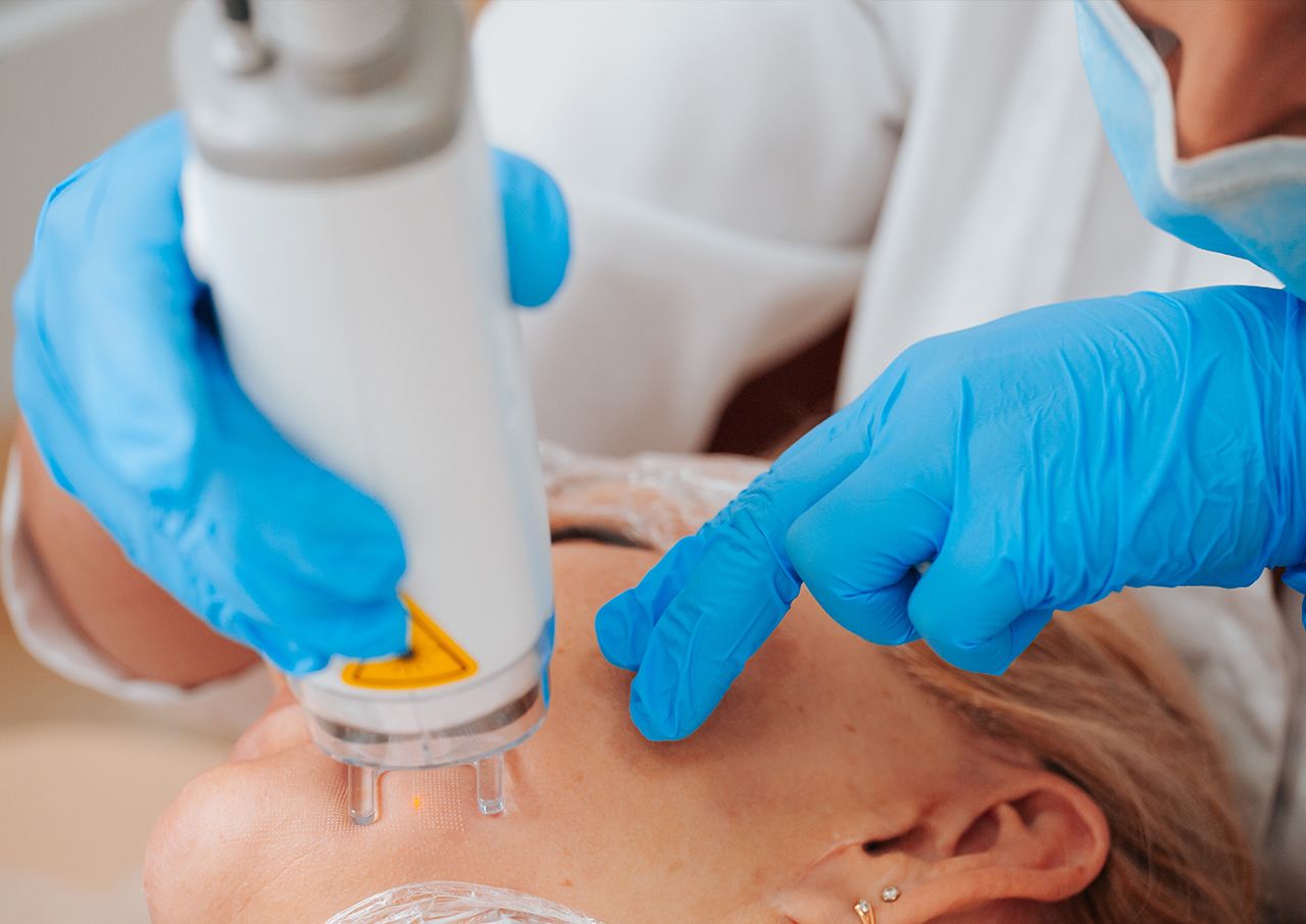 laser-resurfacing