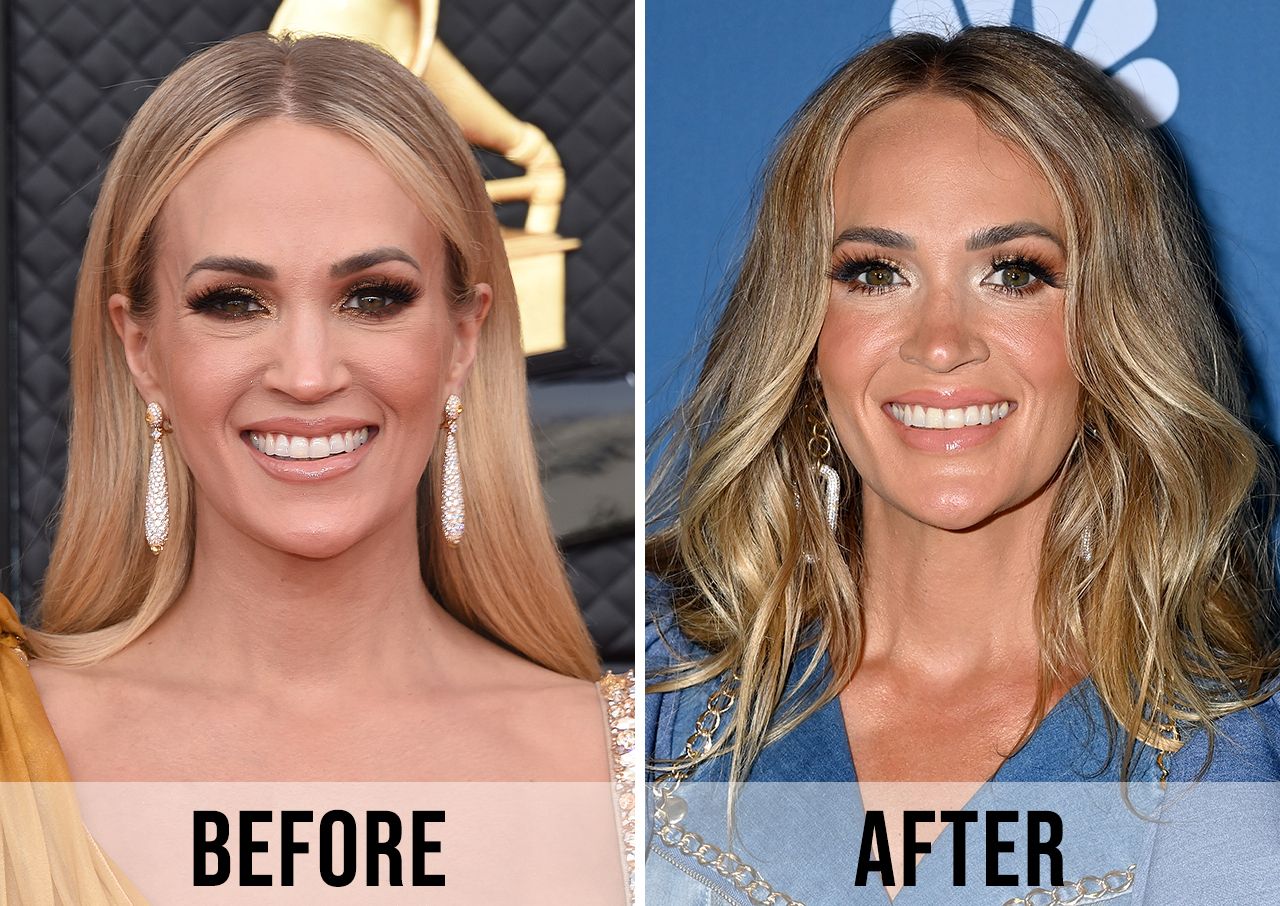 carrie underwood plastic surgery