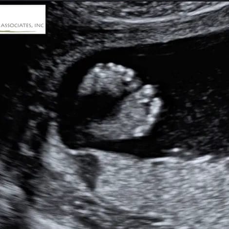 Anne V Supermodel Anne V used a sonogram showing her little one's