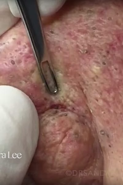 Blackhead