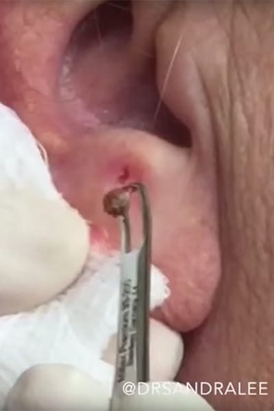 Blackhead