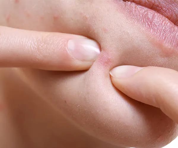 pimple pop