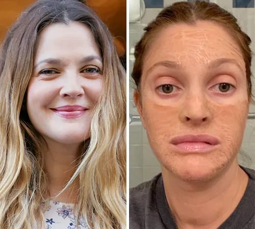 Drew Barrymore facial treatment