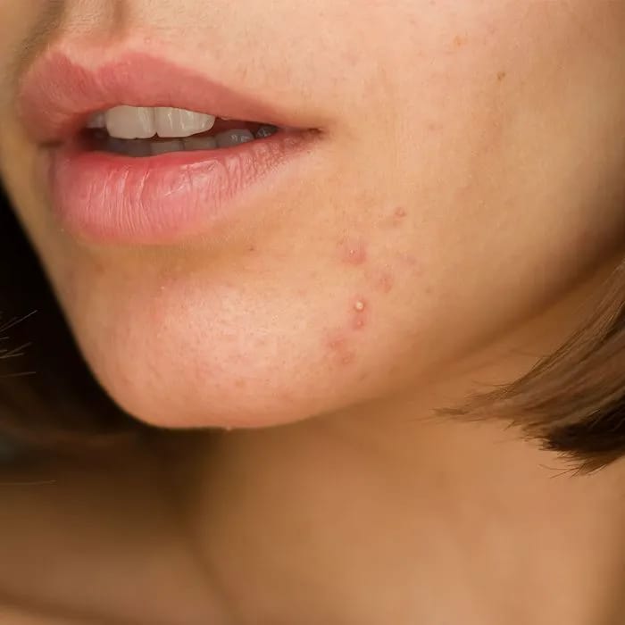 chin-acne