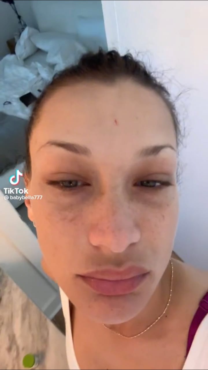 Bella Hadid bruised face jaw infection TikTok video