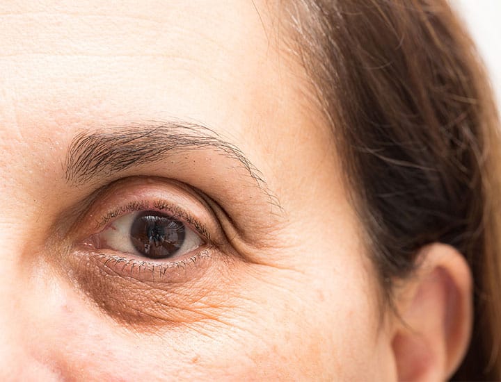 closeup-undereye