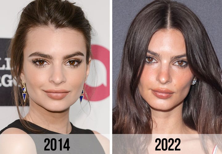 emily ratajkowski side-by-side comparison plastic surgery