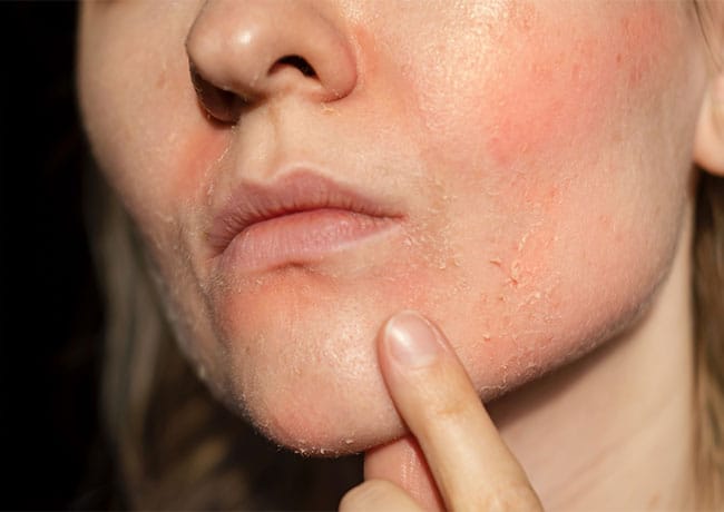 woman-flaky-skin