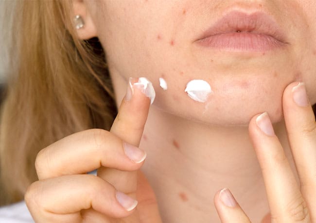 toothpaste-on-pimples