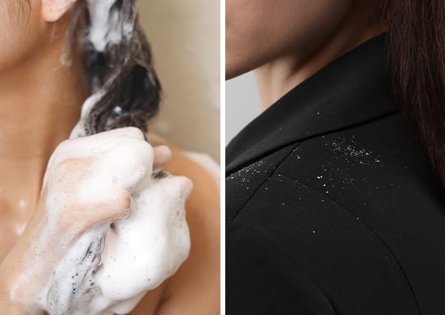 shampooing-hair-dandruff