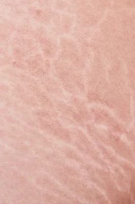 Stretch marks