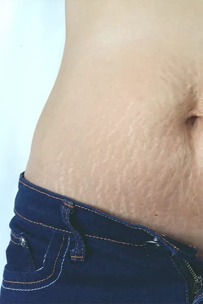 Stretch marks