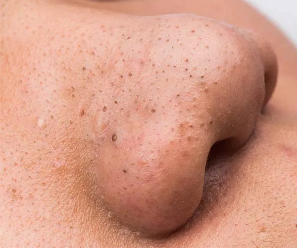 Nose Blackheads