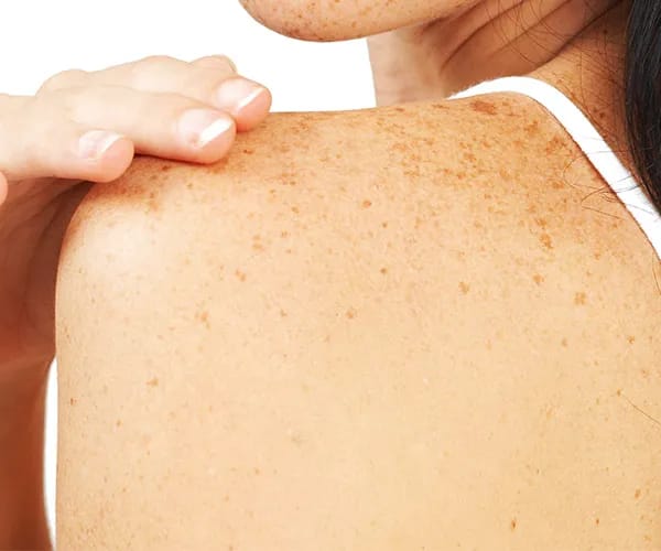 freckles meaning