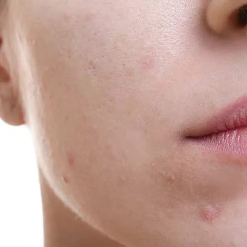 Breakfast foods that may clog pores and harm skin health.