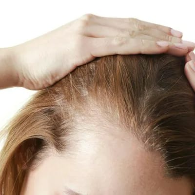 thinning red hair