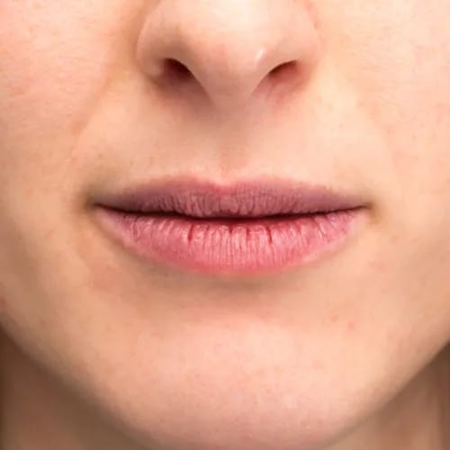 chapped lips