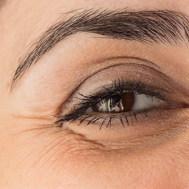 undereye bags