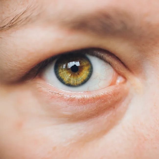 undereye bags