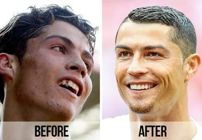 Cristiano Ronaldo teeth before and after