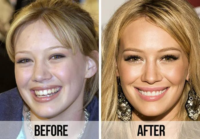 Hilary Duff teeth before and after