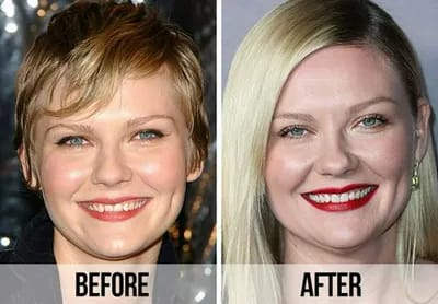 Kirsten Dunst teeth before and after
