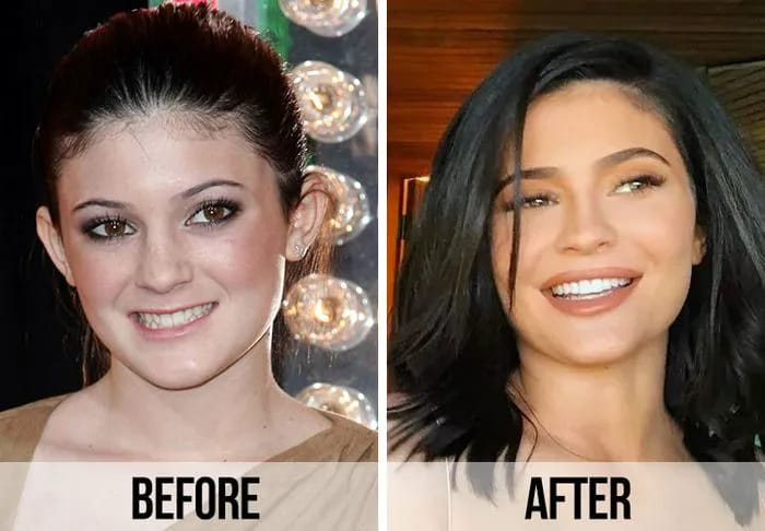 Kylie Jenner teeth before and after
