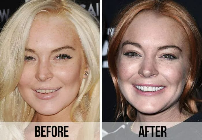 Lindsay Lohan teeth before and after
