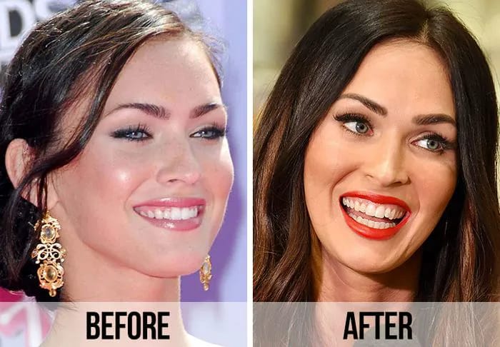 Megan Fox teeth before and after