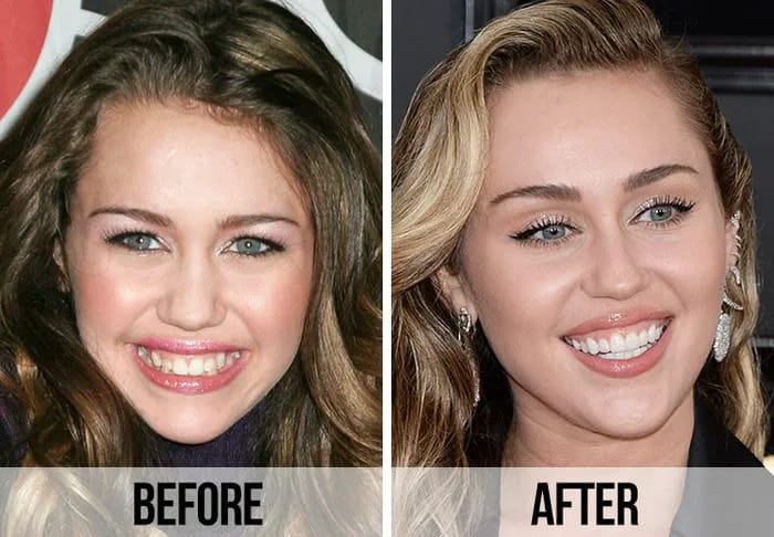 Miley Cyrus teeth before and after