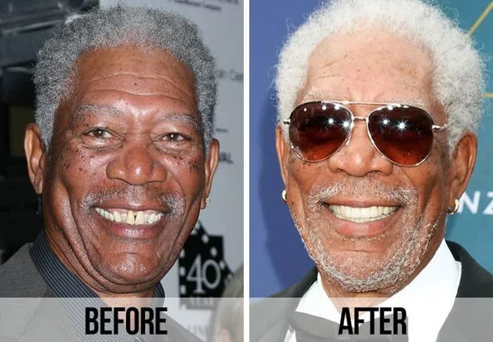 Morgan Freeman teeth before and after