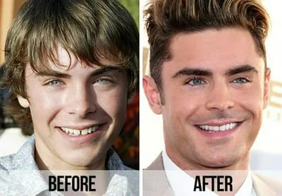 Zac Efron teeth before and after