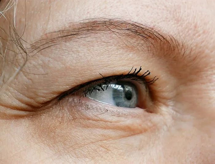 hooded-eyelid