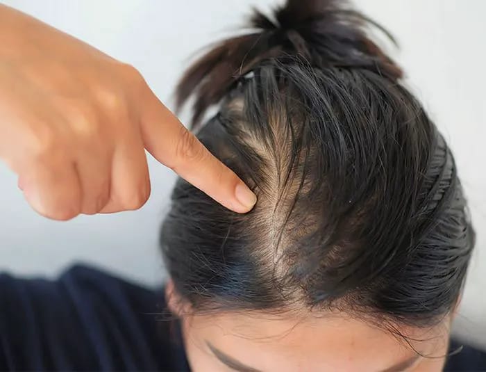 hair-loss-bald-patches