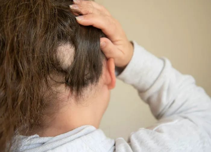 bald-spot
