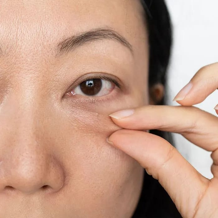 woman-pinching-puffy-under-eye-skin
