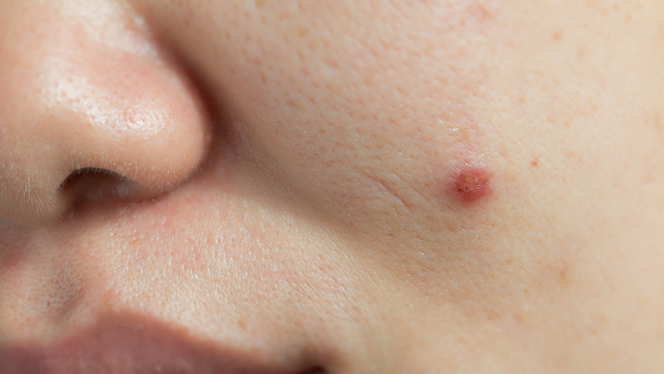 How to stop acne swelling SHEfinds