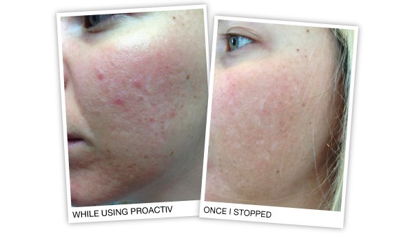 effects of proactiv on the skin