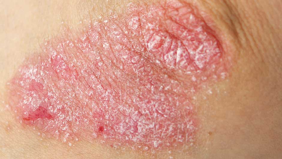 The One Thing You Should Never Do If You Have Eczema Eczema Tips