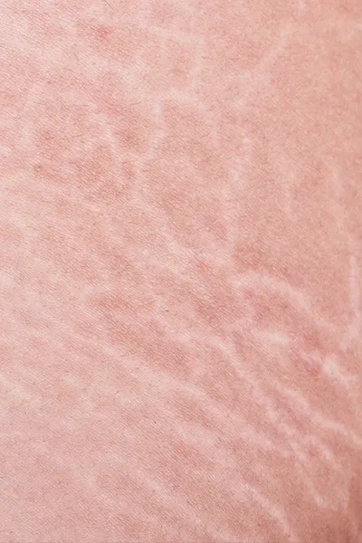 Stretch marks