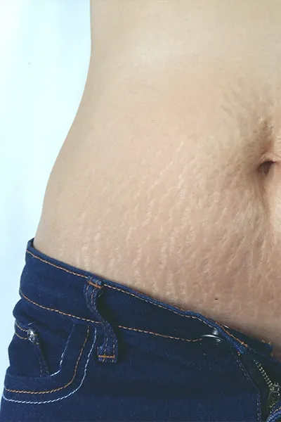 Stretch marks
