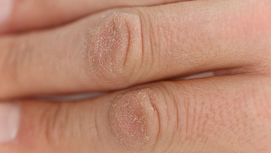 3 AtHome Remedies For Dry Hands SHEfinds