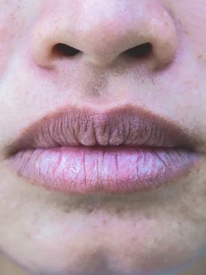dry lips