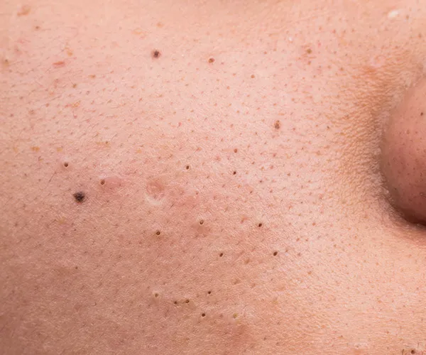 Mineral oil Blackheads
